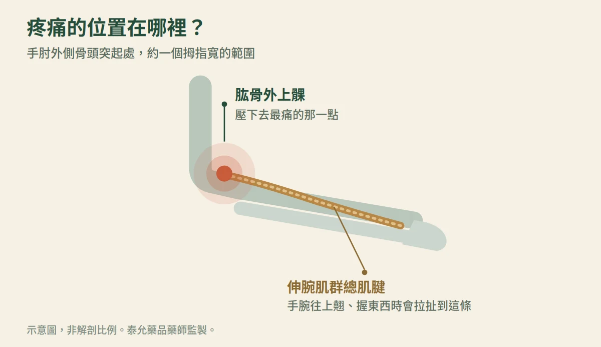手肘外側肱骨外上髁與伸腕肌群總肌腱的位置示意圖，標示壓痛點位置